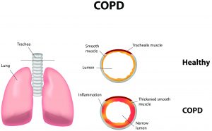 COPD Chart